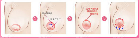 乳房下垂矫正手术方式1