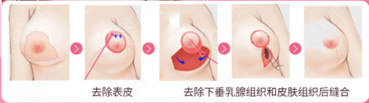 乳房下垂矫正手术方法2