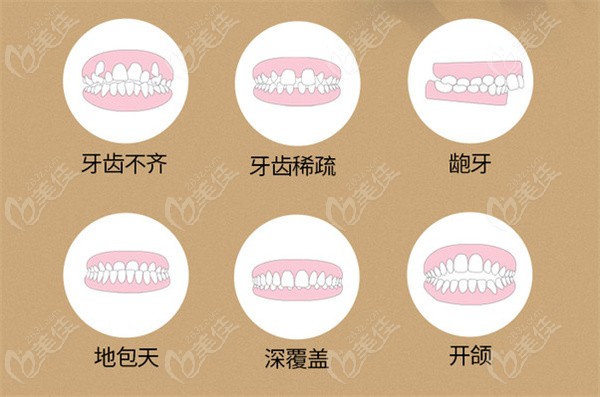 牙齿矫正的几种畸形类型