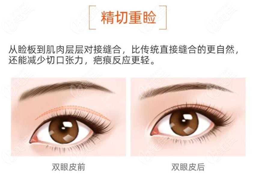 安庆维多利亚双眼皮怎么样，眼综合技术优势