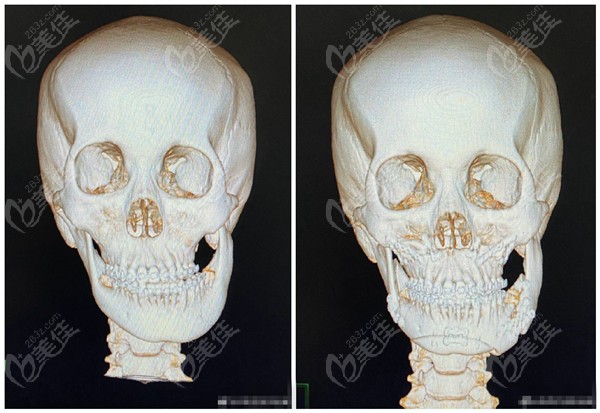 李运峰医生做正颌手术改善歪脸面部对称对比照