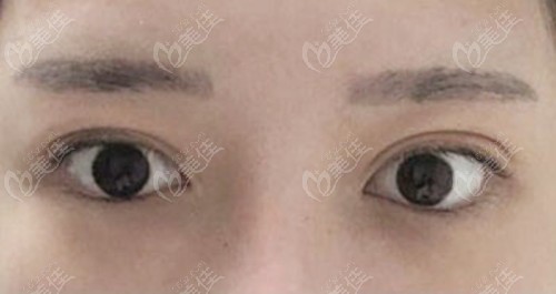 韩国双眼皮修复成功实例:来丽整形全切双眼皮修复和前眼角过大修复3个月成效对比