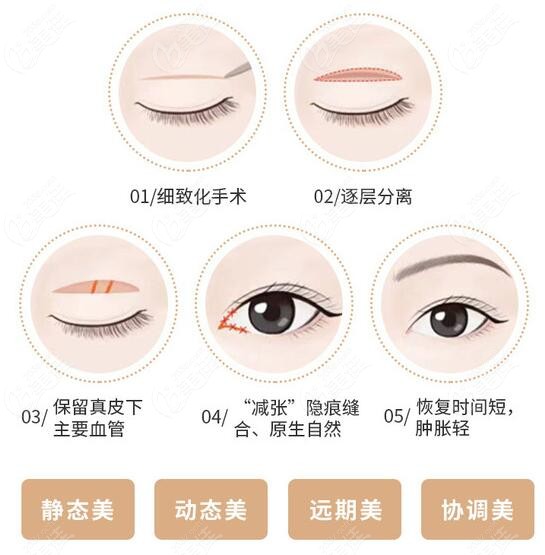 常州美贝尔做双眼皮的技术怎么样