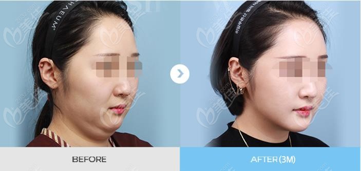 韩国面部吸脂手术恢复前后对比图