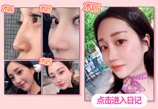 韩国秀美颜整形鹰钩鼻修复实例图