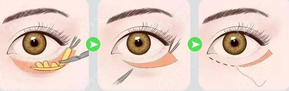 杭州时光范眉清做外切眼袋手术示意图