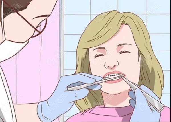 周口口腔做牙齿矫正