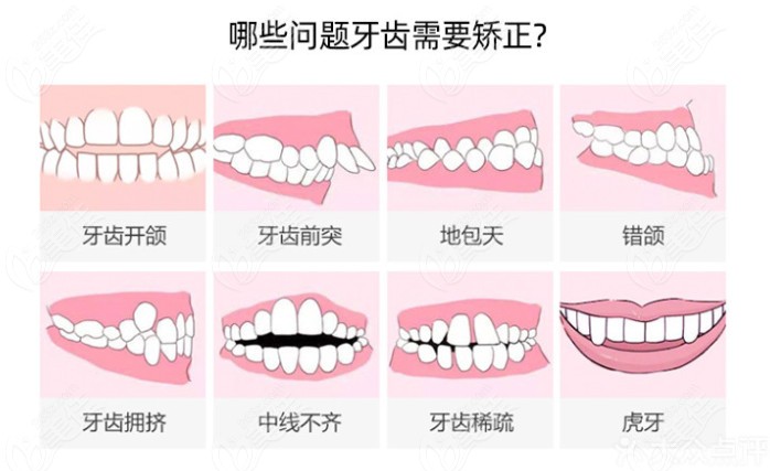 了解下牙齿矫正的适应症有哪些吧