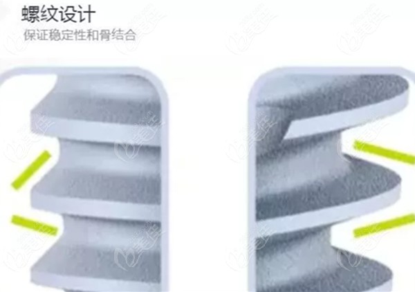 法国安卓健anthogyr种植牙的螺纹设计
