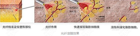 光纤溶脂过程图示