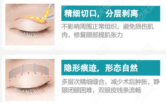 遵义修复双眼皮比较好的医院 遵义修复双眼皮比较好的医院