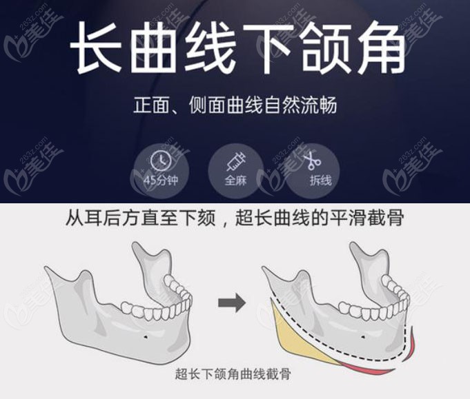 上海华美做长曲线下颌角技术优势