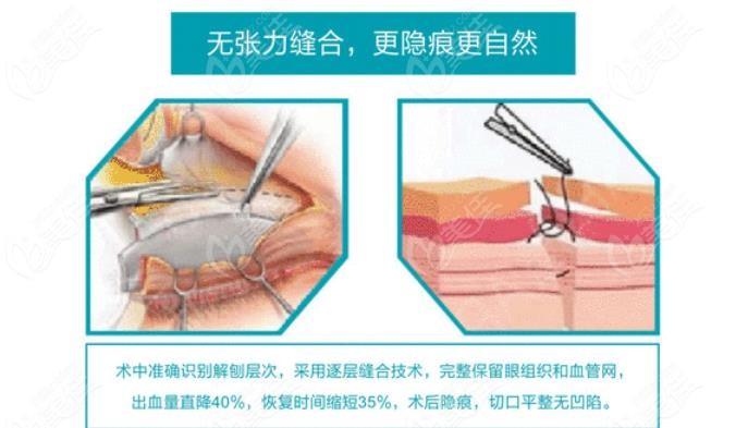 山西省整形外科医院刘晋元做双眼皮技术靠谱