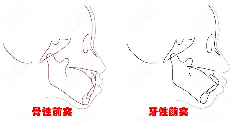 看看骨性前突和牙性前突的区别