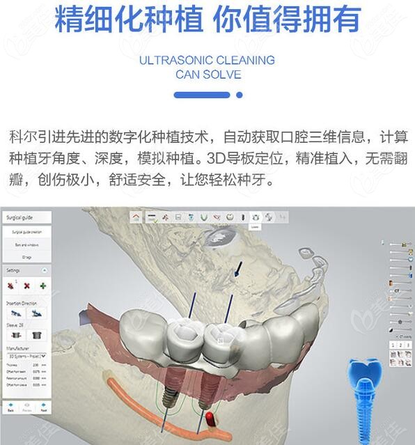 北京科尔口腔数字化种植牙技术