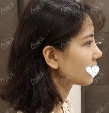 韩国ts整形鼻综合术后一个月图片