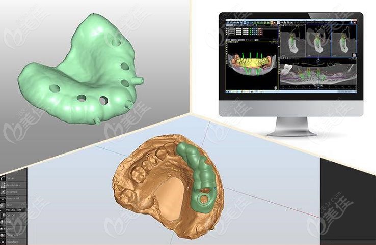 银川艾齿的3D数字化导航模拟种植技术