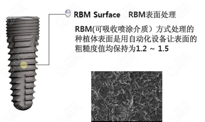 韩国DIO种植体的RBM处理表面
