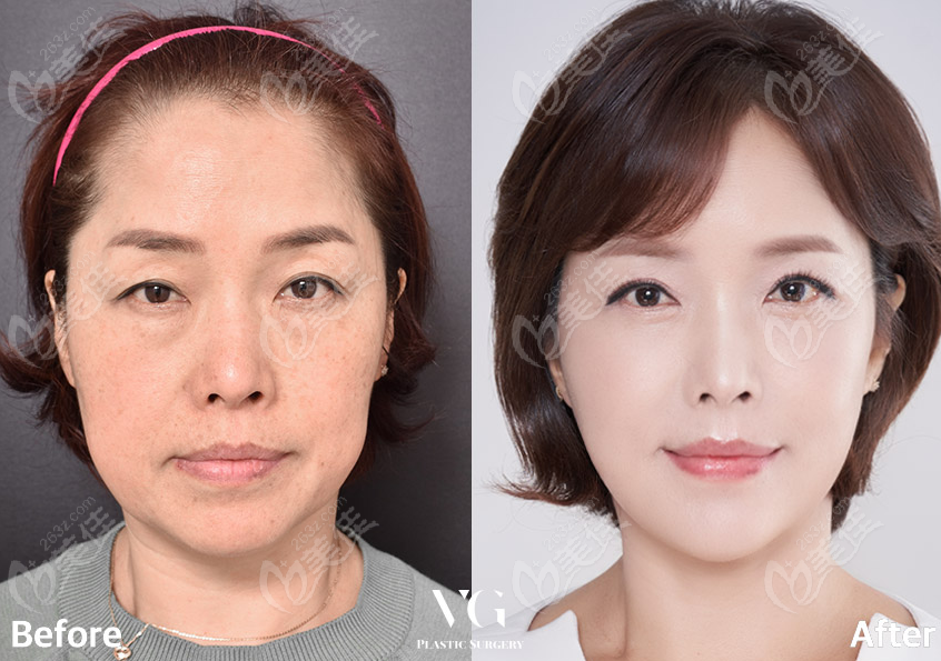 韩国VG百利酷全脸拉皮提升, 下颌角切除前后对比图