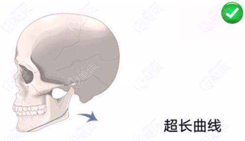 下頜角超長(zhǎng)曲線截骨截骨示意圖