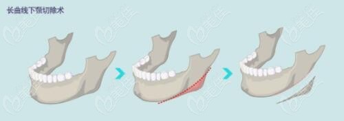 下颌角长曲线截骨方式示意图