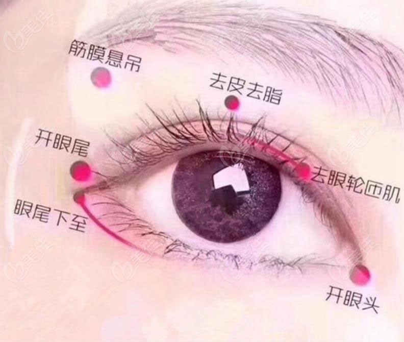 池州灵创割双眼皮技术优势