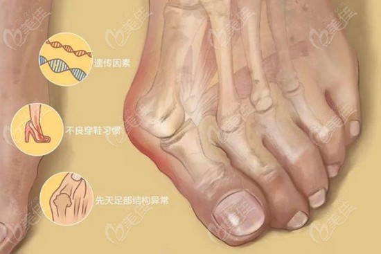 武汉华美分析大脚骨手术形成的原因
