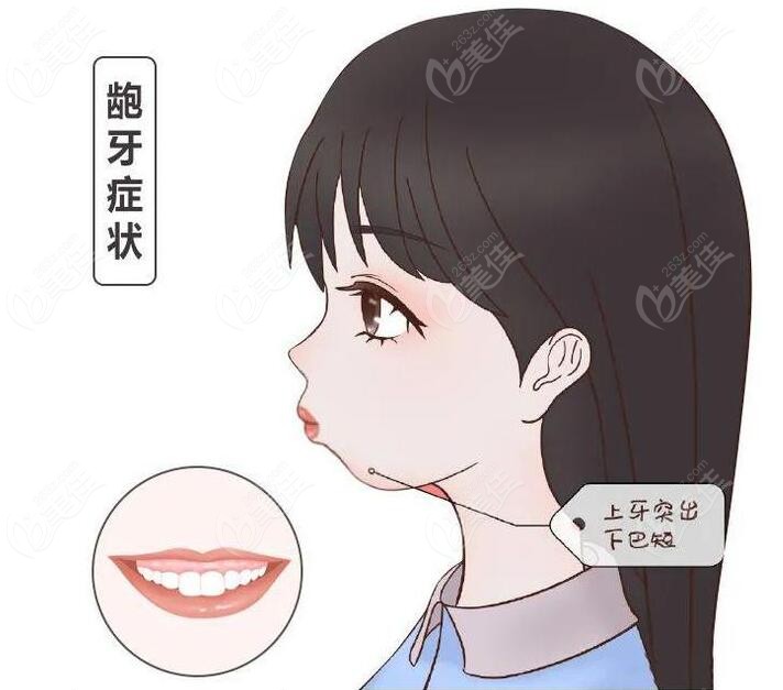 骨性龅牙