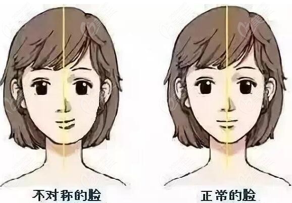 脸型不对称矫正