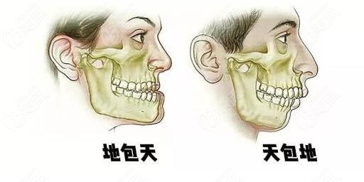 地包天矫正