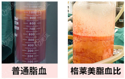 範圍內,避免損傷真皮組織,銳針頭有利於穿透脂肪層淺筋膜進入深層脂肪