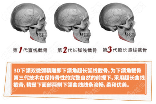 武汉亚韩第三代超长弧线下颌角磨骨优势