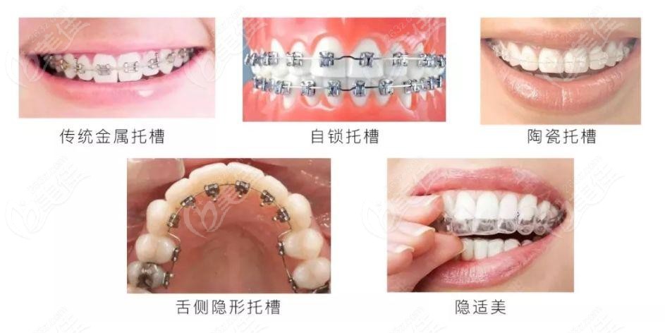 兰州戴牙套价格表