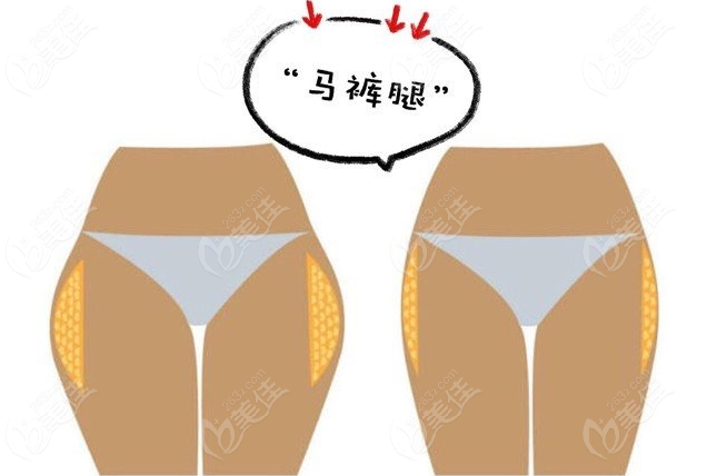 郑州大腿吸脂价格