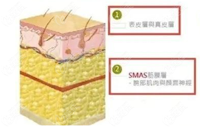 迷你mini小拉皮提升组织示意图