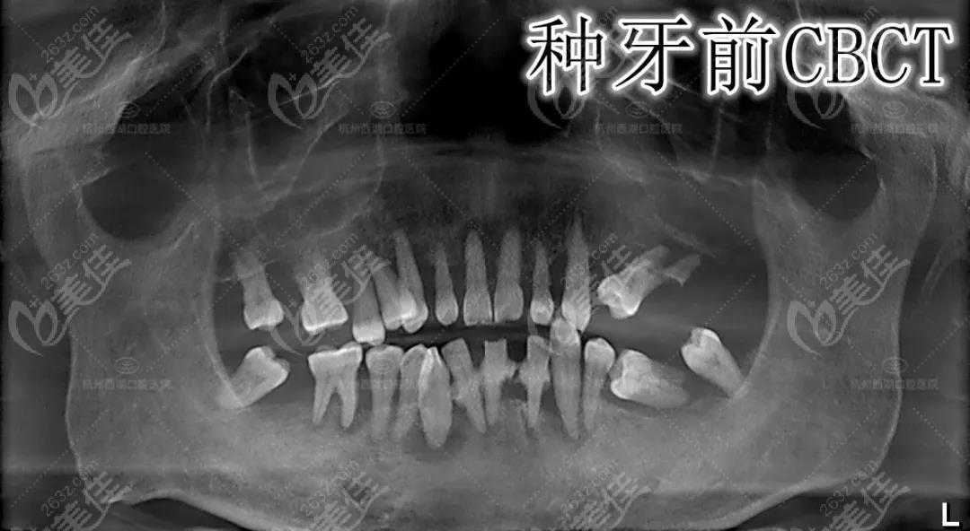 薛先生自述在杭州西湖口腔医院做完AII-ON-6全口即刻种植牙的感受