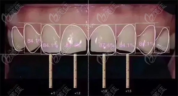 口腔DSD数字化微笑设计是什么