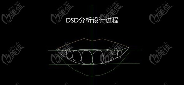 DSD微笑设计过程
