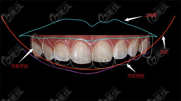dsd微笑设计应用于美学修复