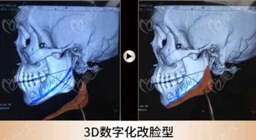 武汉华美磨骨手术前3D数字化改脸型