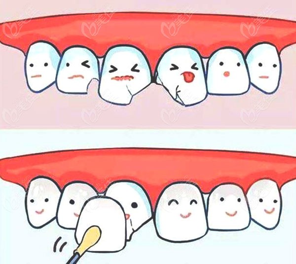 南阳百乐口腔的牙贴面