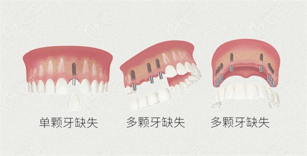 金华种植牙齿缺失种类