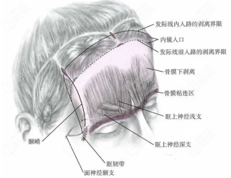 内窥镜小切口除皱优势
