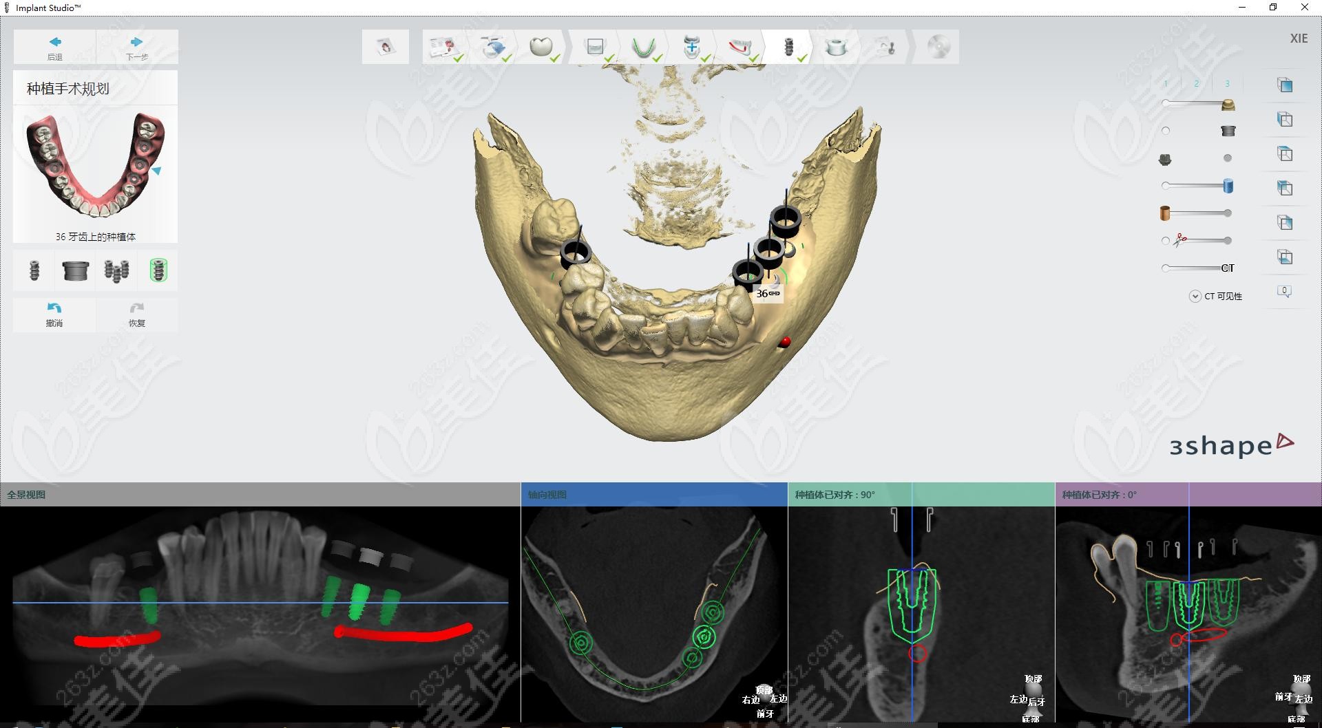 同步齿科3D导板数字化种植技术