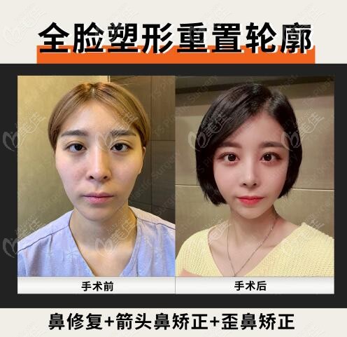 韩国全面部轮廓重塑鼻部变化对比照