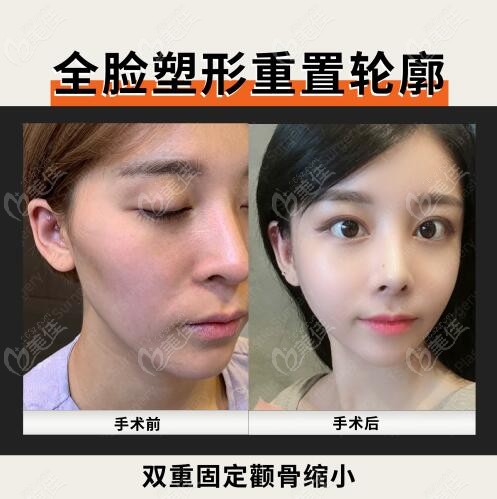 韩国TS全面部轮廓重塑术前术后脸型变化对比照