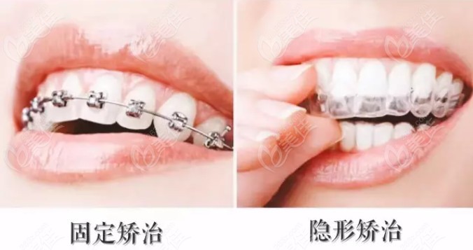来看看固定矫正器和隐形牙套的区别吧