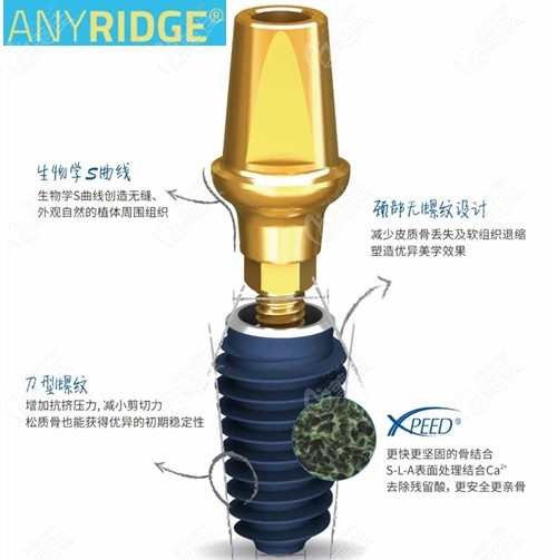 AnyRidge蓝色种植体