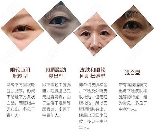 眼袋有几种类型图片