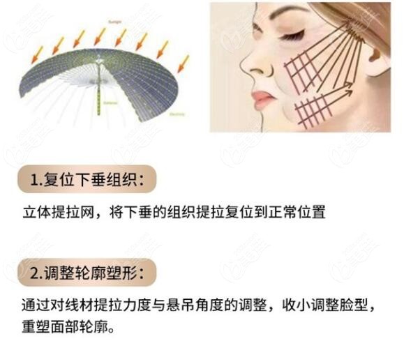 埋线提升技术原理